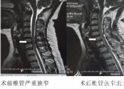 【今日朝陽(yáng)網(wǎng)】厲害！他們消滅了潛伏在頸椎管里的“腫瘤君”（范廣明）