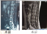 【今日朝陽網】朝陽又一例神經外科新術式獲得成功